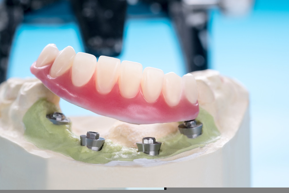 Dental implant retained denture on model